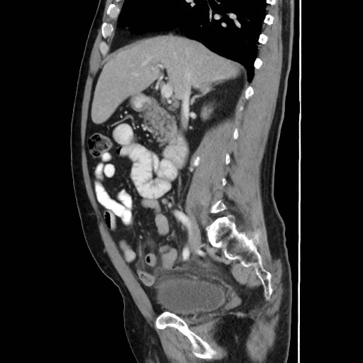 Cecal mass causing appendicitis (Radiopaedia 59207-66531 C 26).jpg