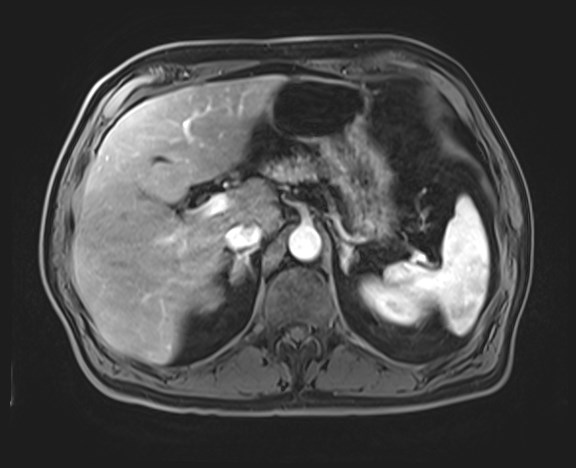 Cecal mass causing appendicitis (Radiopaedia 59207-66532 H 42).jpg