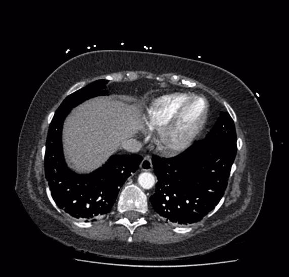 Celiac artery severe stenosis and dissection (Radiopaedia 44128-47842 B 1).jpg