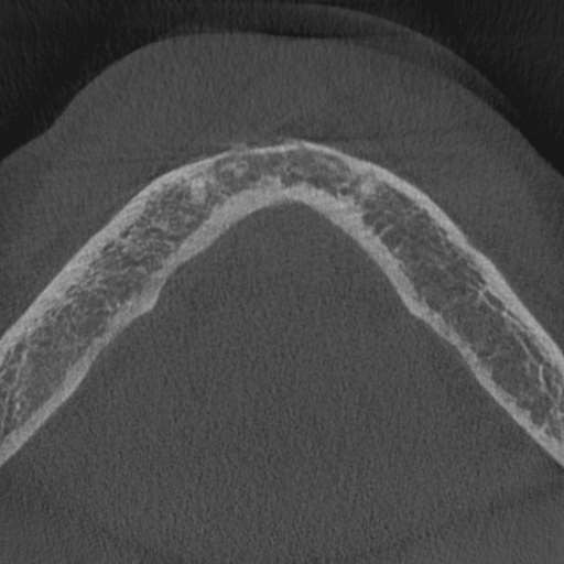 Cemento-osseous dysplasia (Radiopaedia 48251-53126 Axial non-contrast 14).jpg