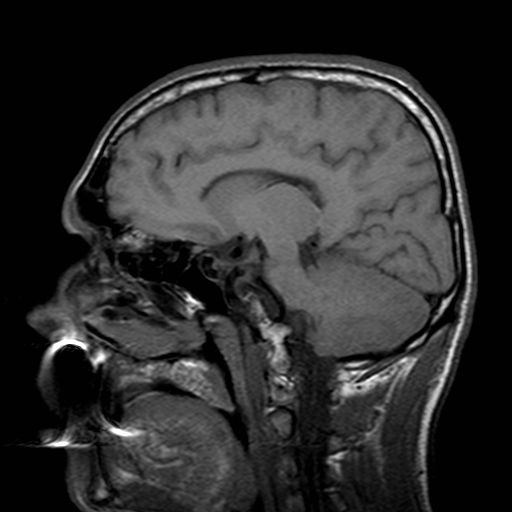 File:Central-variant posterior reversible encephalopathy syndrome (PRES) (Radiopaedia 43880-47358 Sagittal T1 14).jpg
