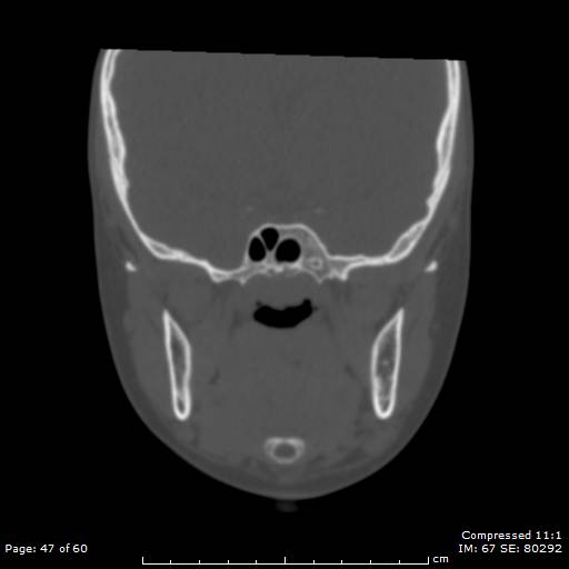 File:Central giant cell granuloma (Radiopaedia 45612-49754 Coronal bone window 47).jpg