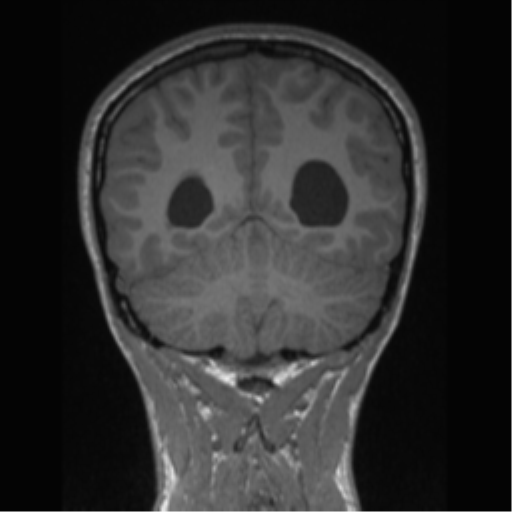 Central neurocytoma (Radiopaedia 37664-39557 Coronal T1 26).png