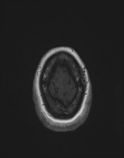 File:Central neurocytoma (Radiopaedia 84497-99872 Axial T1 174).jpg