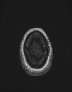 Central neurocytoma (Radiopaedia 84497-99872 Axial T1 175).jpg