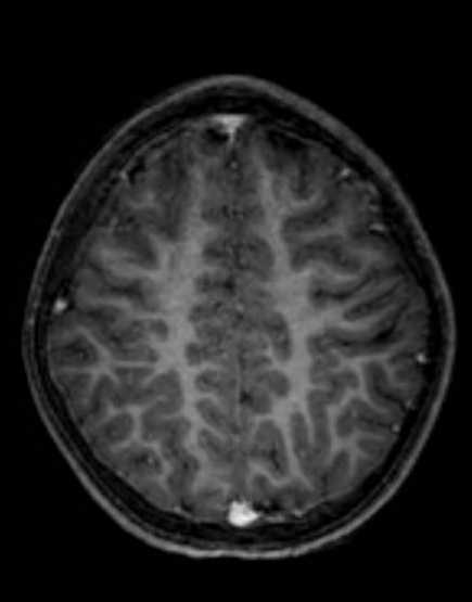Cerebellar abscess (Radiopaedia 73727-84563 Axial T1 C+ fat sat 85).jpg