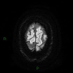 Cerebellar abscess (Radiopaedia 78135-90678 Axial DWI 27).jpg