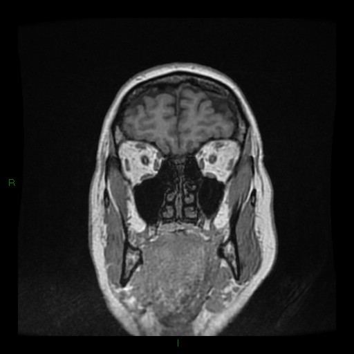 Cerebellar abscess (Radiopaedia 78135-90678 Coronal T1 C+ 27).jpg