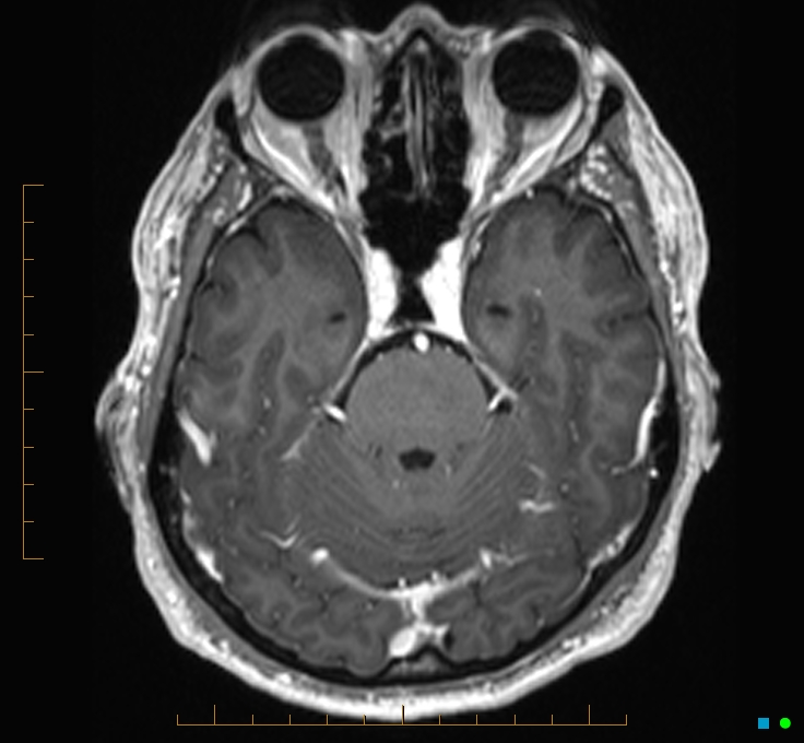 Cerebellar gangliocytoma (Radiopaedia 65377-74422 Axial T1 C+ 37).jpg