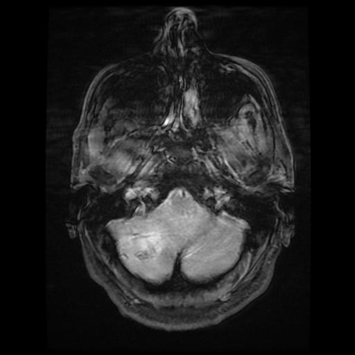 File:Cerebellar hemangioblastoma (Radiopaedia 88055-104622 Axial Gradient Echo 3).jpg