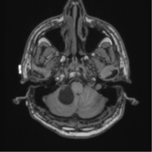File:Cerebellar hemangioblastomas and pituitary adenoma (Radiopaedia 85490-101176 Axial T1 12).png