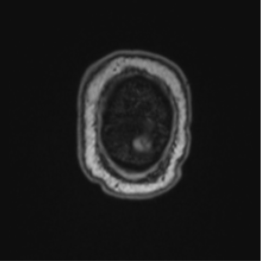 Cerebellar hemangioblastomas and pituitary adenoma (Radiopaedia 85490-101176 Coronal T1 9).png