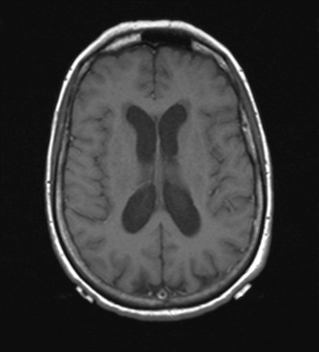 File:Cerebellar metastases (Radiopaedia 24038-24249 Axial T1 5).jpg