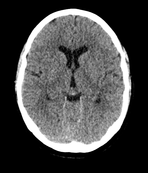 File:Cerebellar metastases - colorectal adenocarcinoma (Radiopaedia 40947-43652 Axial non-contrast 30).png