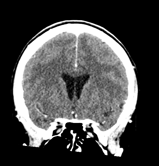 Cerebellar metastases - colorectal adenocarcinoma (Radiopaedia 40947-43652 Coronal C+ 37).png