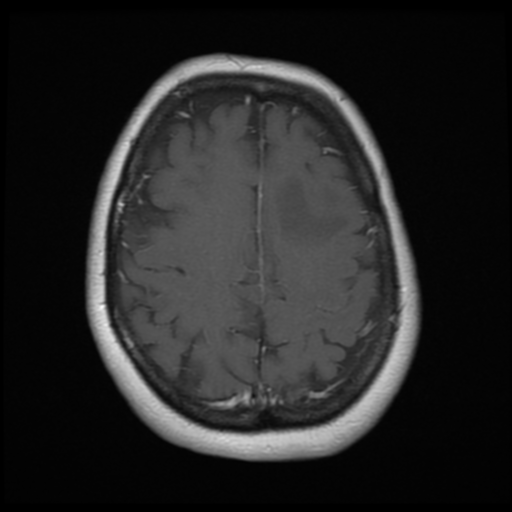 File:Cerebellar metastasis (cystic appearance) (Radiopaedia 41395-44268 Axial T1 C+ 18).png