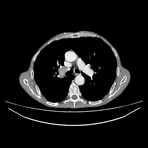 Cerebellar metastasis - lung tumor (Radiopaedia 69317-79150 A 15).jpg