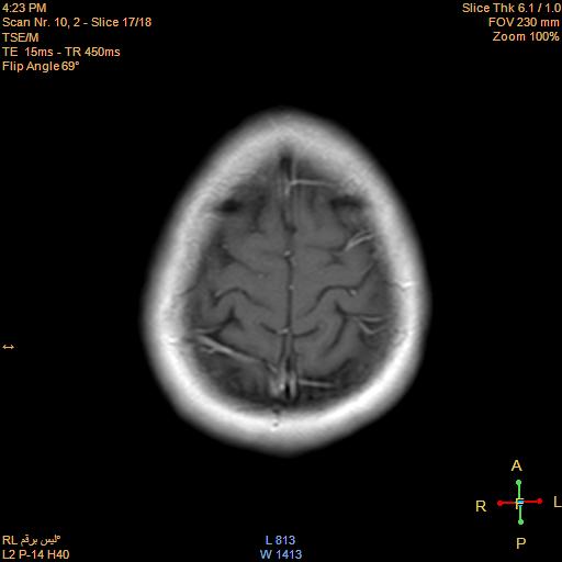 File:Cerebellopontine angle meningioma (Radiopaedia 22488-22525 Axial T1 C+ 16).jpg