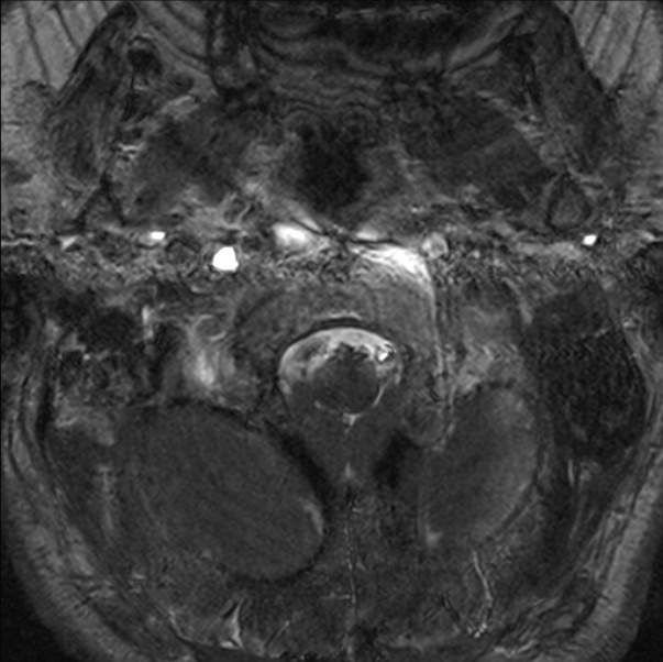 Cerebellopontine angle meningioma (Radiopaedia 24459-24764 I 1).jpg