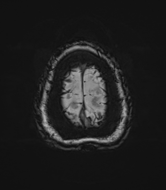 Cerebellopontine angle meningioma (Radiopaedia 48434-53348 Axial SWI 87).png