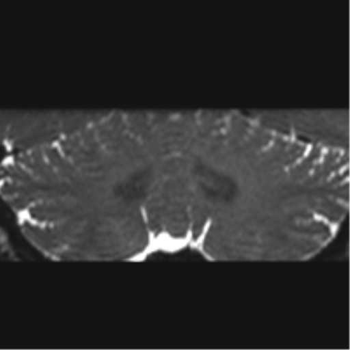 Cerebellopontine angle meningioma (Radiopaedia 48434-53348 Coronal T2 14).png