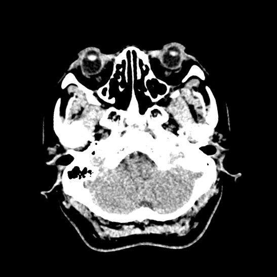 File:Cerebellopontine angle meningioma (Radiopaedia 53561-59592 Axial non-contrast 11).jpg