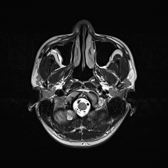 Cerebral abscess (Radiopaedia 24212-24478 Axial T2 11).jpg