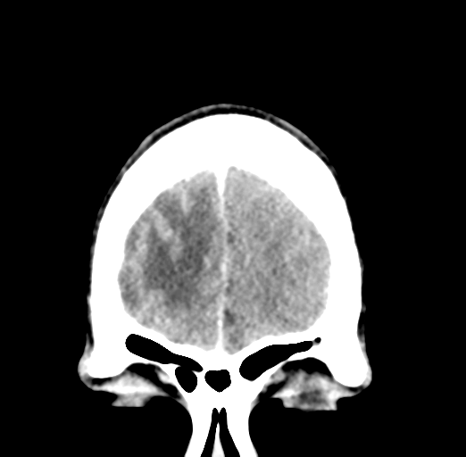 Cerebral abscess (Radiopaedia 60342-68008 Coronal C+ delayed 9).png