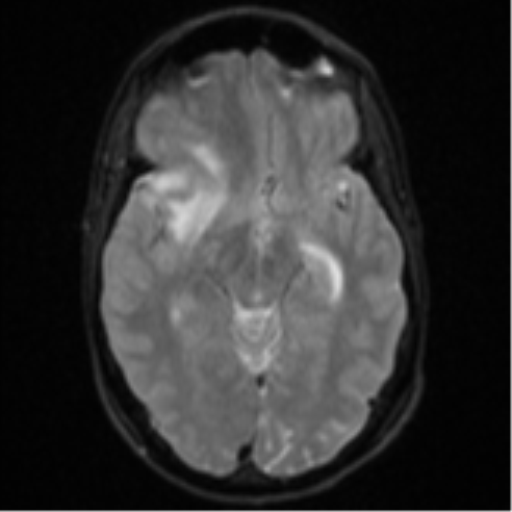 Cerebral abscess (Radiopaedia 60342-68009 Axial DWI 15).png