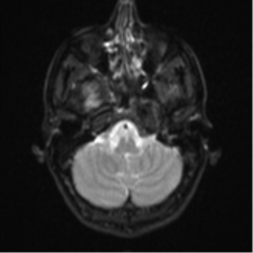 Cerebral abscess (Radiopaedia 60342-68009 Axial DWI 6).png