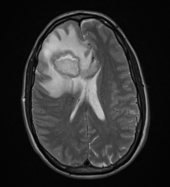 File:Cerebral abscess (Radiopaedia 60342-68009 Axial T2 22).png