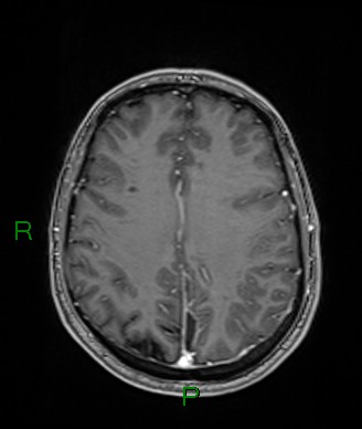 Cerebral abscess and subdural empyema (Radiopaedia 84436-99779 Axial T1 C+ 31).jpg