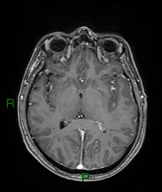 Cerebral abscess and subdural empyema (Radiopaedia 84436-99779 Axial T1 C+ 44).jpg