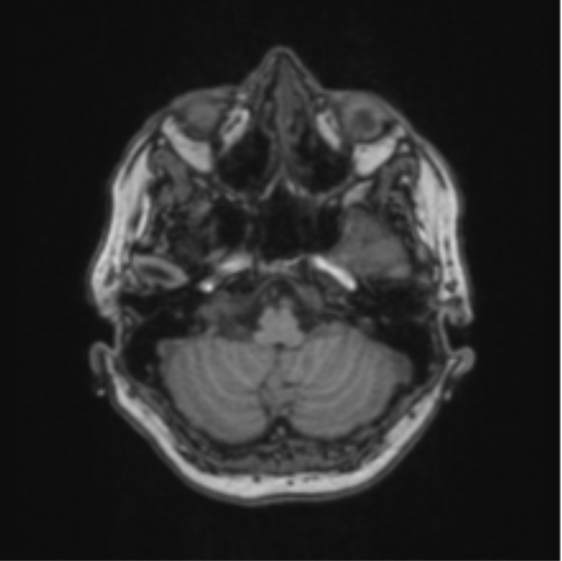 Cerebral abscess from pulmonary arteriovenous malformation (Radiopaedia 86275-102291 Axial T1 17).png