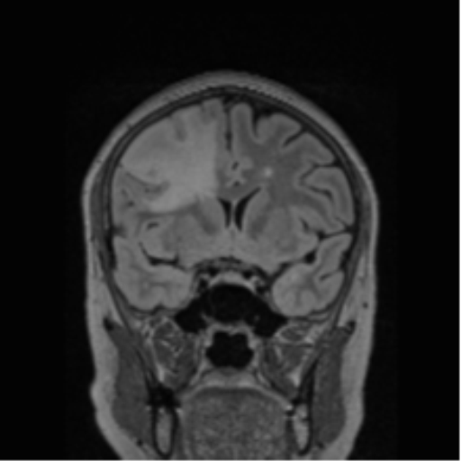 Cerebral abscess from pulmonary arteriovenous malformation (Radiopaedia 86275-102291 Coronal FLAIR 57).png