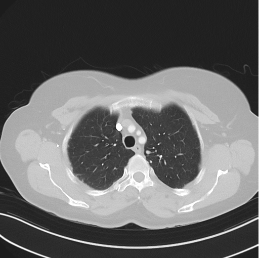 File:Cerebral abscess from pulmonary arteriovenous malformation (Radiopaedia 86275-102292 Axial lung window 17).png