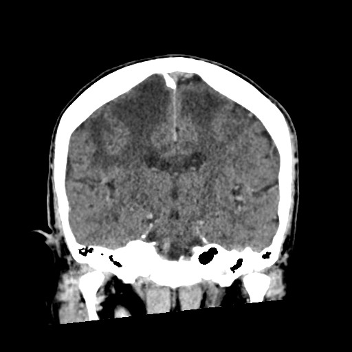 Cerebral amyloid angiopathy-related inflammation (Radiopaedia 74836-85848 Coronal non-contrast 39).jpg