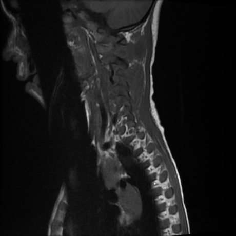 File:Cerebral and spinal tuberculosis (Radiopaedia 90489-107838 Sagittal T1 11).jpg