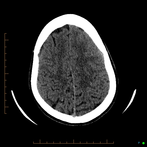 Cerebral arteriovenous malformation (AVM) (Radiopaedia 78162-90706 Axial non-contrast 50).jpg