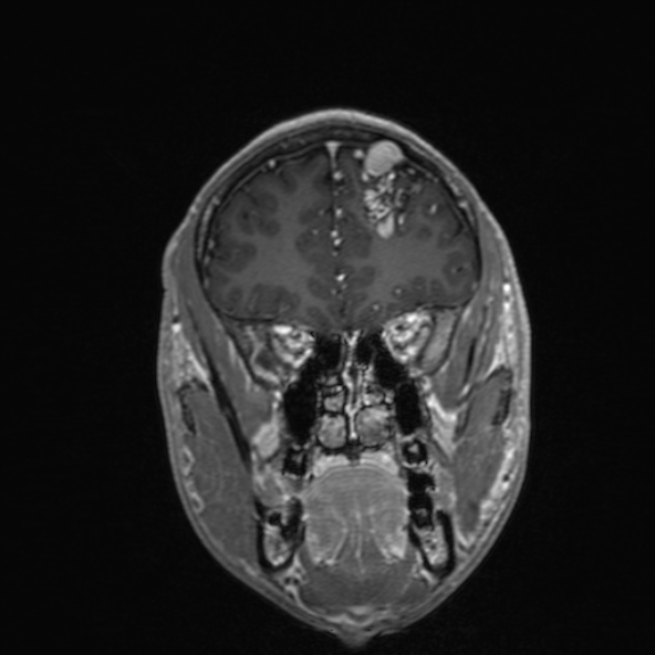Cerebral arteriovenous malformation (Radiopaedia 30198-30813 F 18).jpg