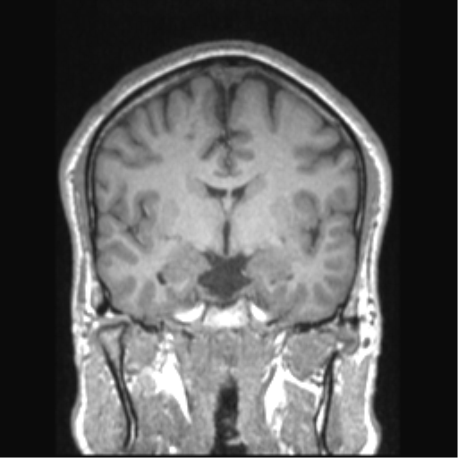 Cerebral arteriovenous malformation (Radiopaedia 39259-41506 Coronal T1 52).png