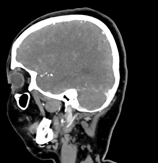 Cerebral arteriovenous malformation (Radiopaedia 73830-84645 D 25).jpg