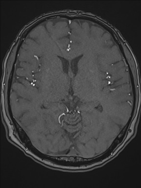 Cerebral arteriovenous malformation (Radiopaedia 84015-99245 Axial TOF 127).jpg
