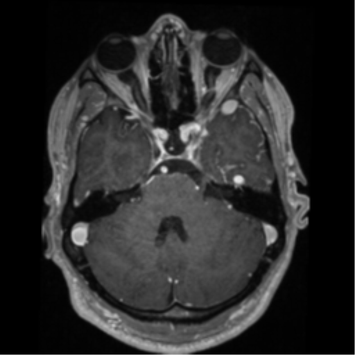 Cerebral arteriovenous malformation - huge (Radiopaedia 35734-37272 Axial T1 C+ 19).png