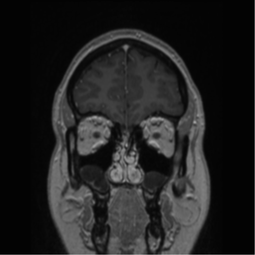 Cerebral cavernoma and development venous anomaly (Radiopaedia 37603-39482 Coronal T1 C+ 77).png