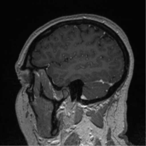 File:Cerebral cavernoma and development venous anomaly (Radiopaedia 37603-39482 Sagittal T1 C+ 23).png