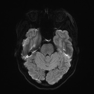 File:Cerebral cavernous venous malformation (Radiopaedia 70008-80021 Axial DWI 40).jpg