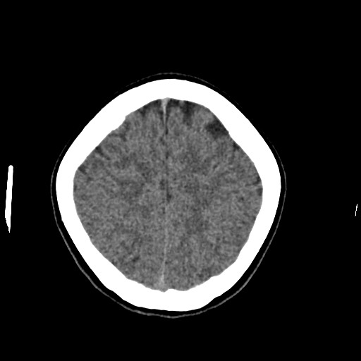 Cerebral cavernous venous malformation (Radiopaedia 70008-80022 Axial non-contrast 43).jpg