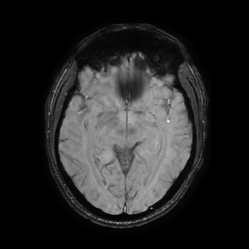 File:Cerebral cavernous venous malformation (Zabramski type II) (Radiopaedia 85511-101198 Axial SWI 60).jpg