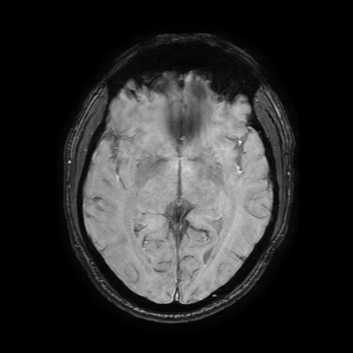 Cerebral cavernous venous malformation (Zabramski type II) (Radiopaedia 85511-101198 Axial SWI 62).jpg